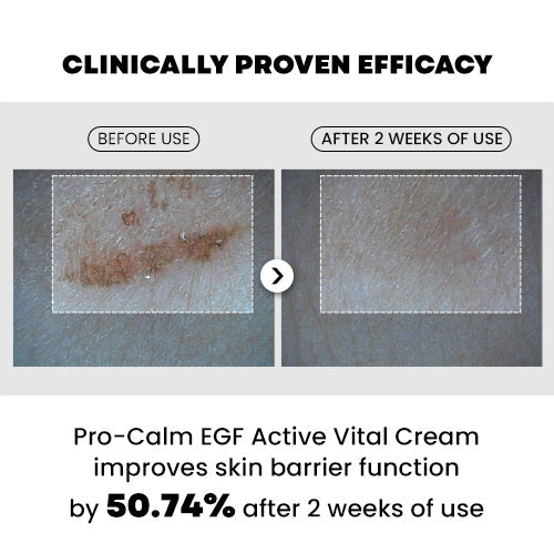 PRO-CALM EGF Active Vital Cream - clinically proven efficacy, barrier function improved 50.74 percent after 2 weeks